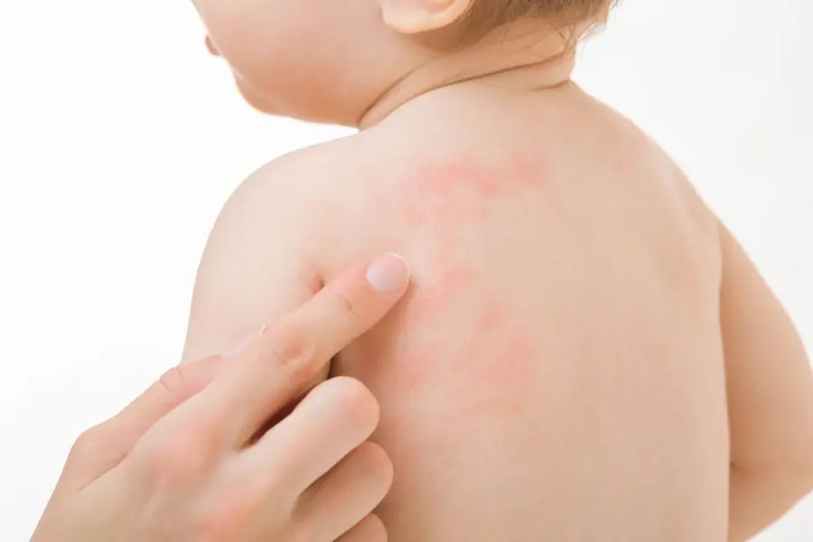 Baby Rashes And Bumps On Skin