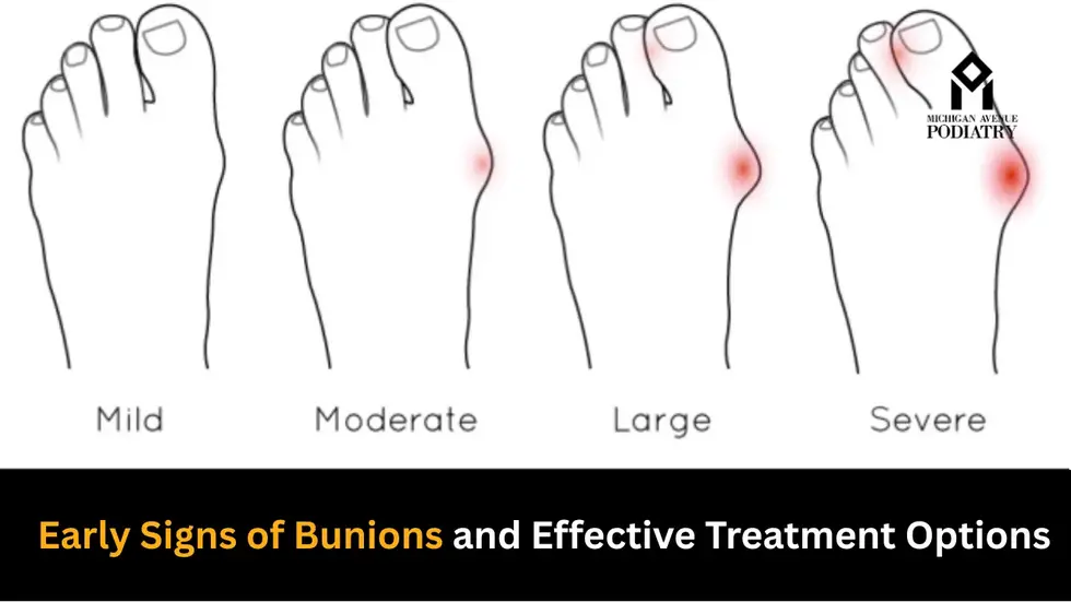 Early Signs Of Bunions And Treatment Options