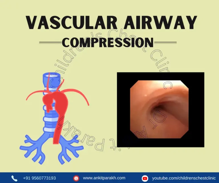 Vascular Airway Compression In Children
