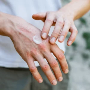 Eczema Treatment Tips - Sidra Family Hospital Eczema Treatment Tips