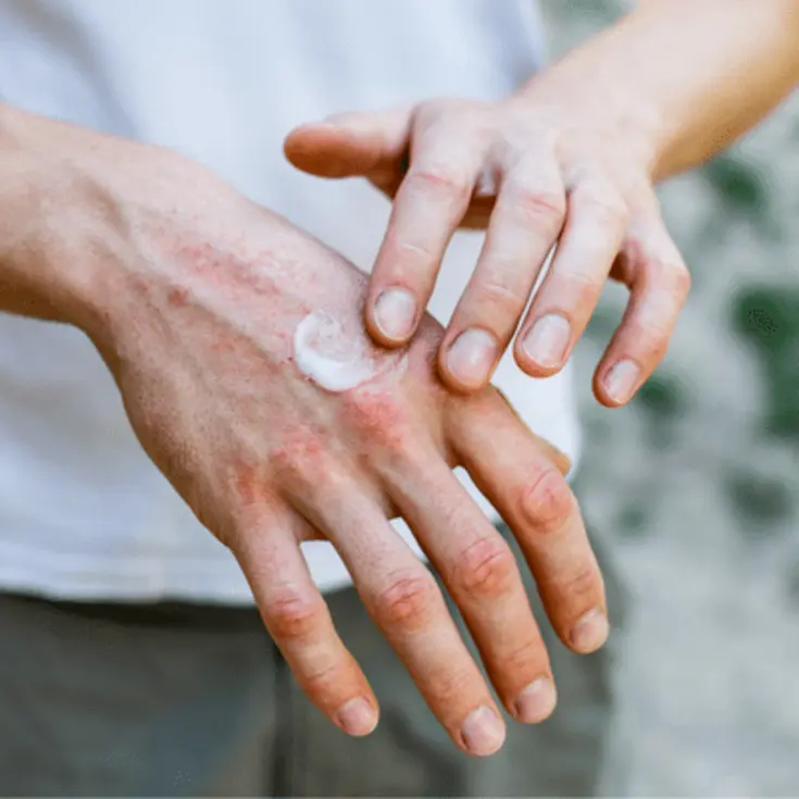 Eczema Treatment Tips