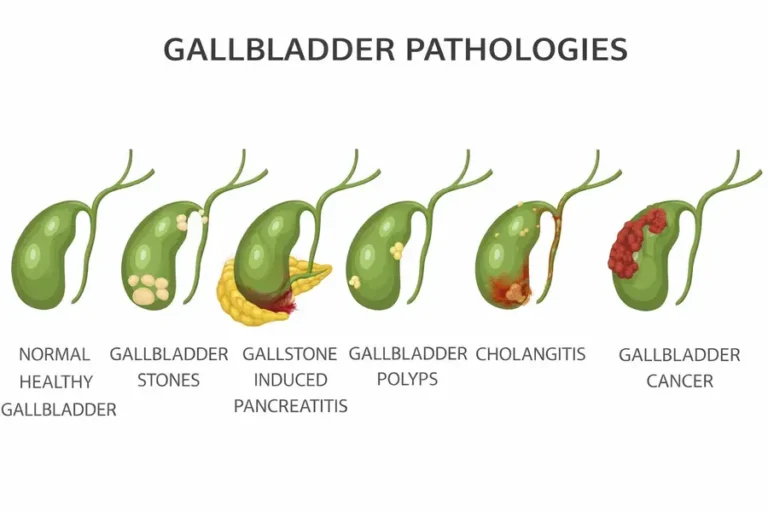 The Hidden Signs Of Gallbladder Disease When To See A Gi Surgeon
