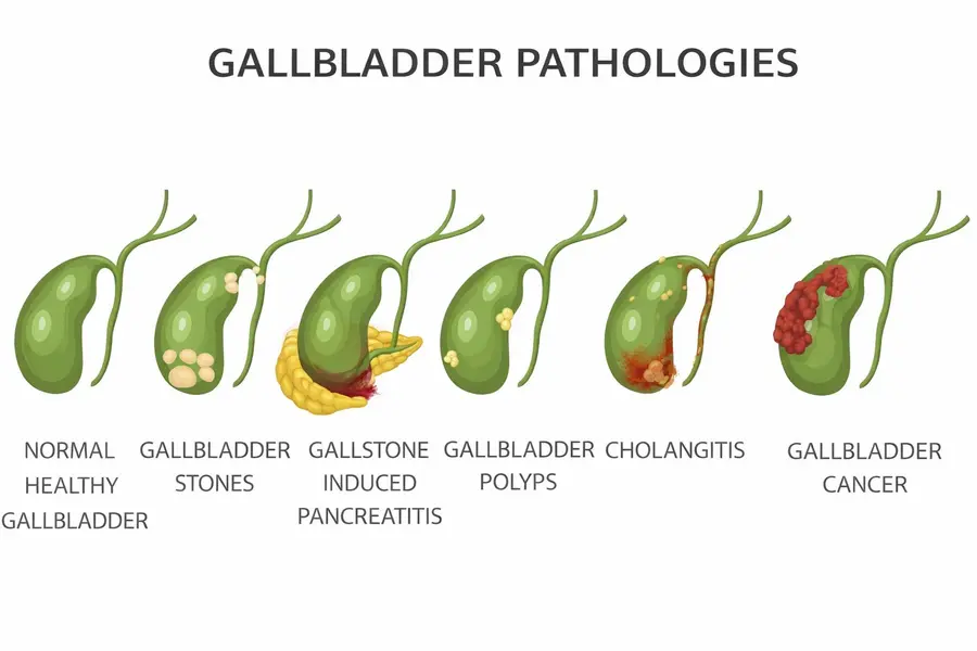 The Hidden Signs Of Gallbladder Disease When To See A Gi Surgeon
