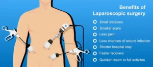 Keyhole Gallbladder Surgery