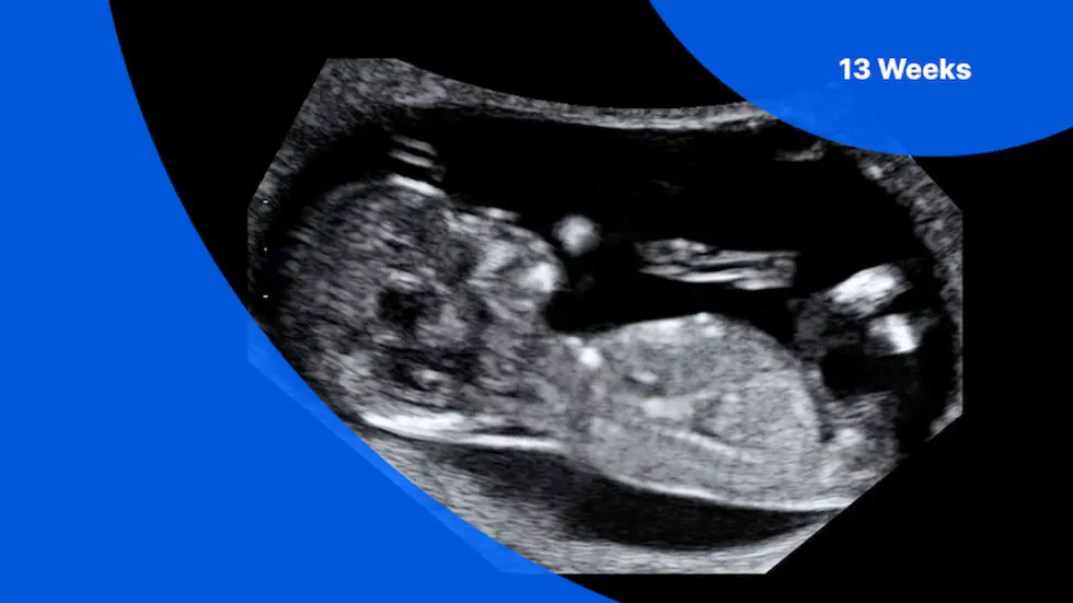 13 Weeks Pregnant Ultrasound