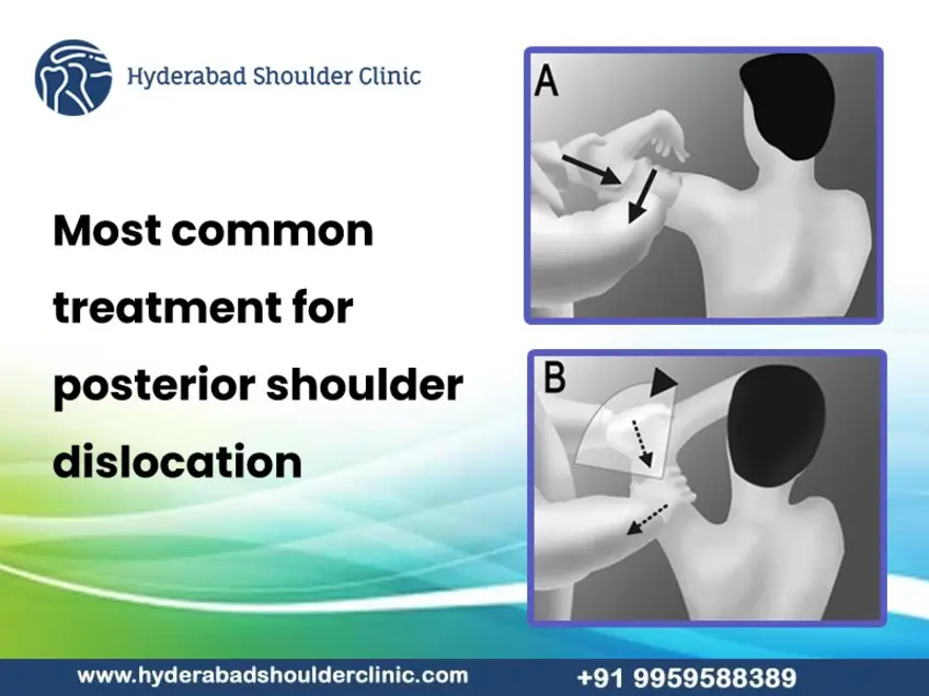 Most Common Treatment For Posterior Shoulder Dislocation