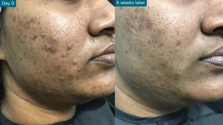 Best Facial Treatment For Acne Why Choose Perfect Skin Solutions