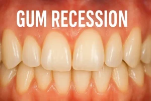 Gum Recession Causes Signs How To Stop It And Treatment - Sidra Family Hospital Gum Recession Causes Signs How To Stop It And Treatment